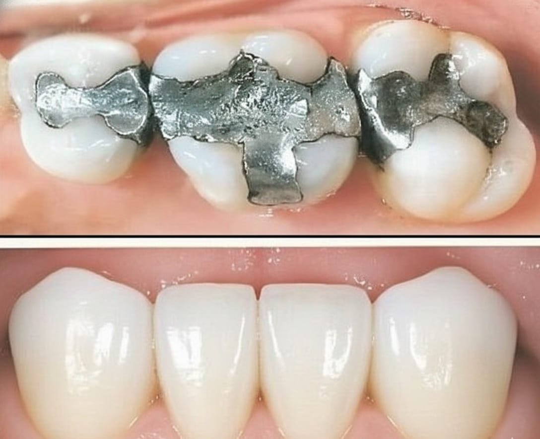 Root Canal Treatment Illustration